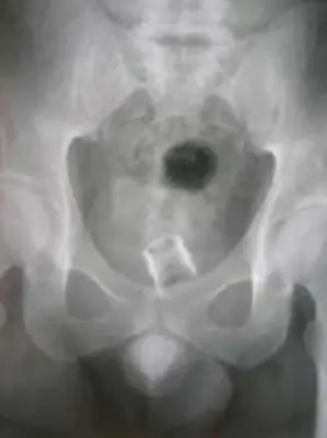 Radiograph from the case bank: Foreign body (ingested or inserted)