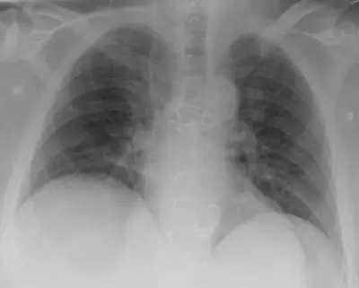Radiograph from the case bank: Central venous catheter