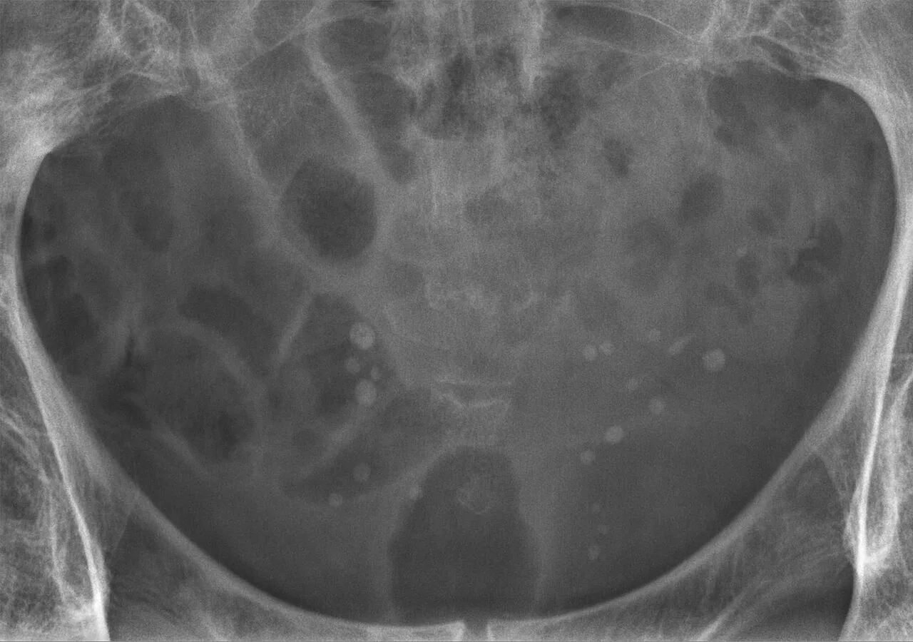 Abdomen radiograph for self-assessment