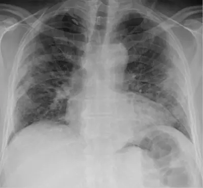 Radiograph from the case bank: COVID-19 pneumonia