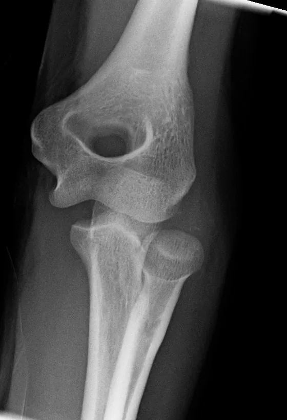 Upper limb radiograph for self-assessment