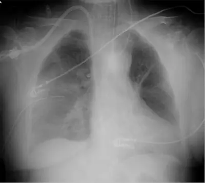 Radiograph from the case bank: Dialysis catheter