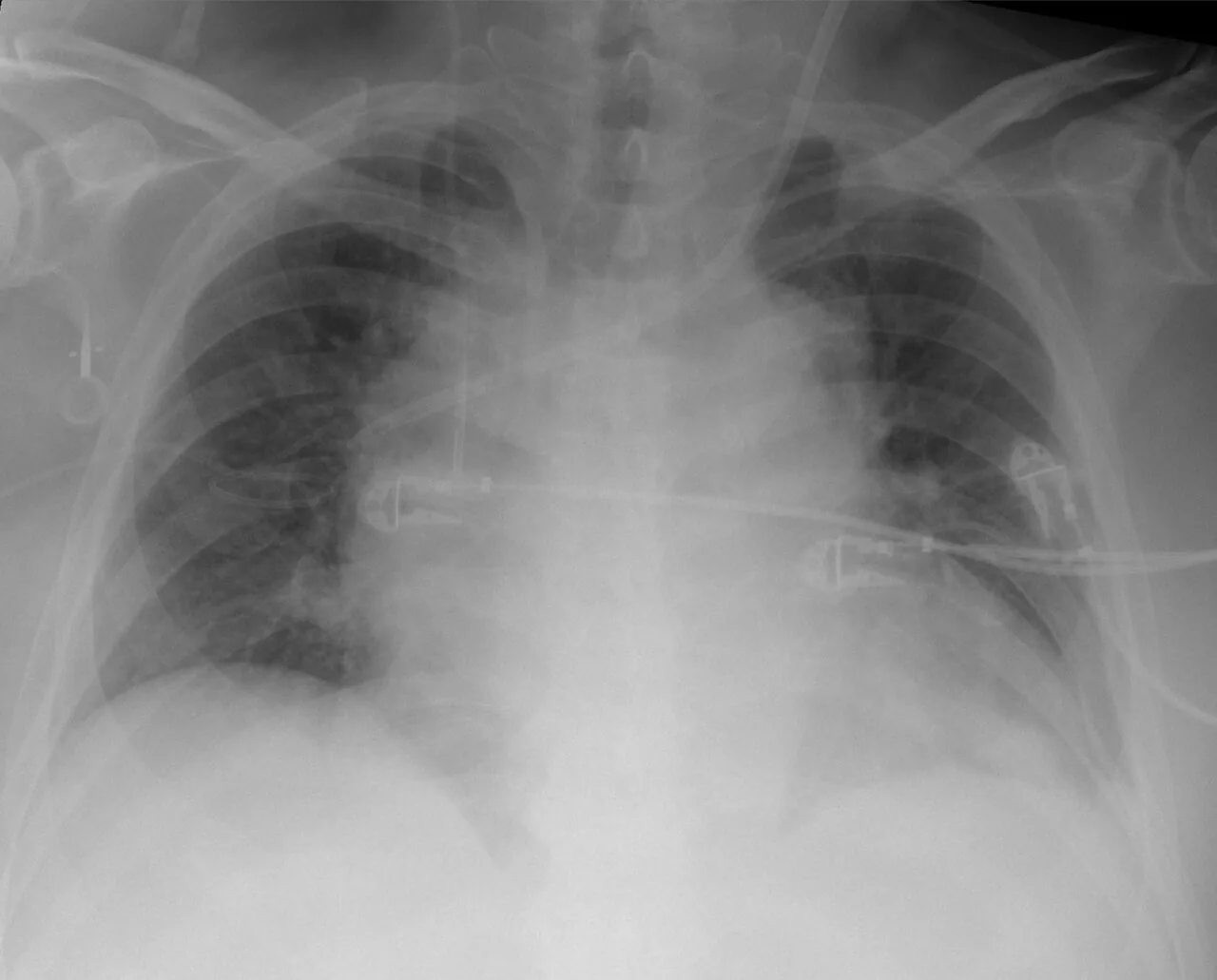 Lines & tubes radiograph for self-assessment