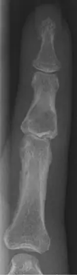Radiograph from the case bank: Enchondroma