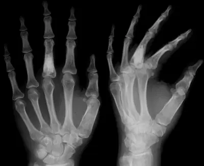 Radiograph from the case bank: Enchondroma