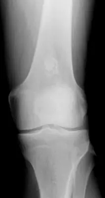 Radiograph from the case bank: Enchondroma