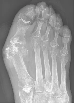 Radiograph from the case bank: Gout