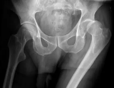 Radiograph from the case bank: Hip dislocation