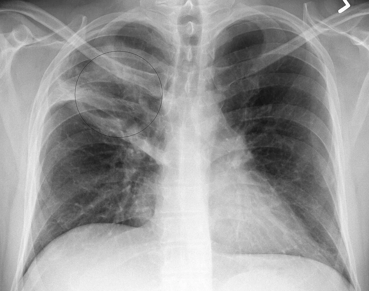 Chest radiograph for self-assessment