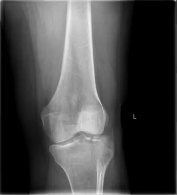 Radiograph from the case bank: Tibial plateau fracture