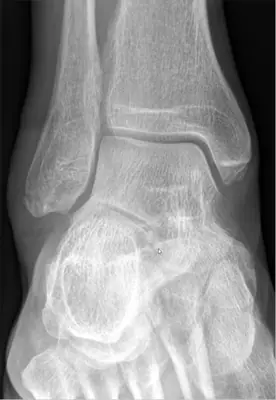 Radiograph from the case bank: Ankle fracture (lateral malleolus)
