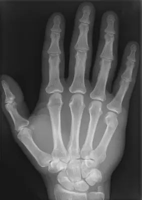 Radiograph from the case bank: Metacarpal fracture