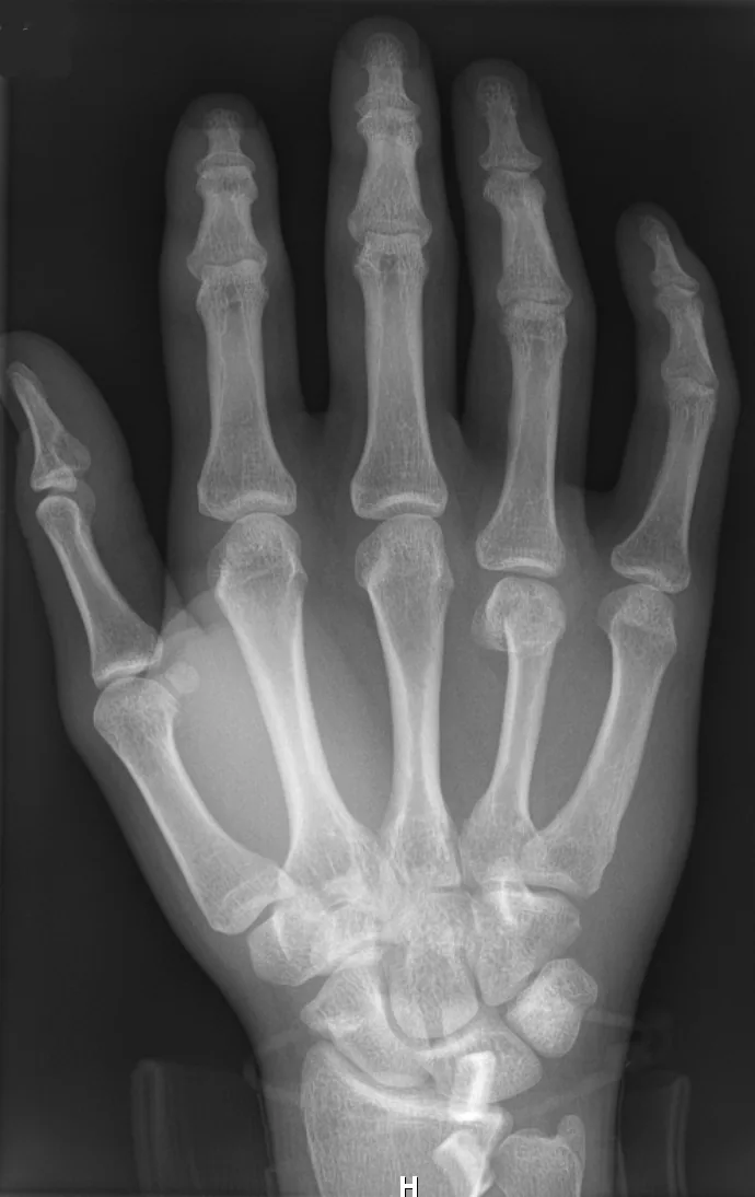 Upper limb radiograph for self-assessment