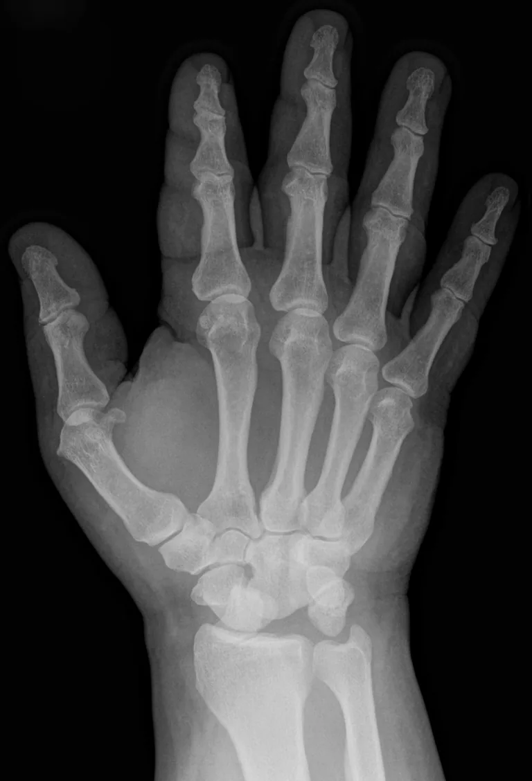 Upper limb radiograph for self-assessment