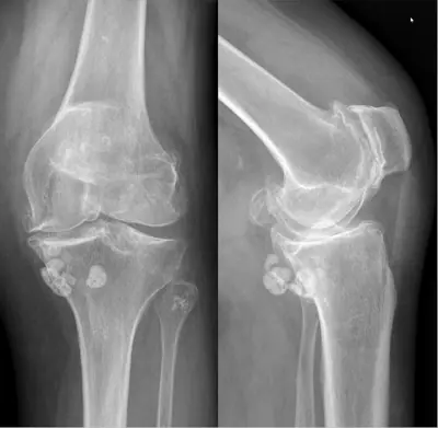 Radiograph from the case bank: Synovial chondromatosis