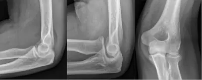 Radiograph from the case bank: Radial head fracture