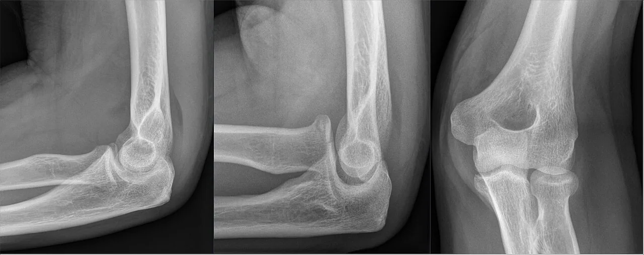 Upper limb radiograph for self-assessment