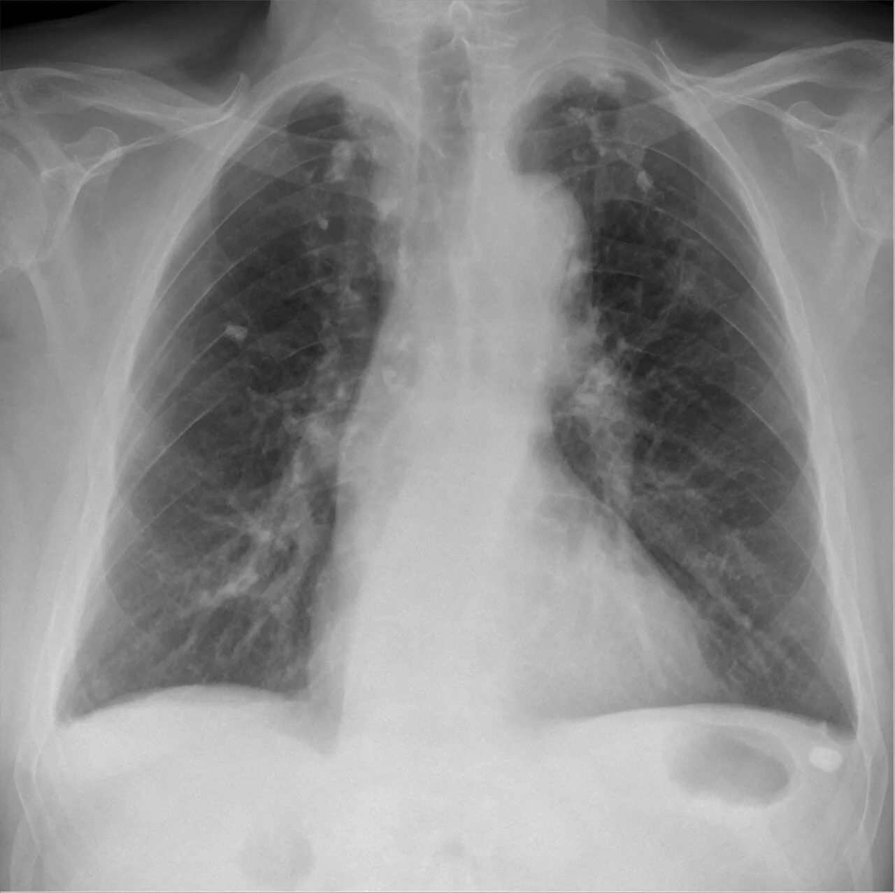 Chest radiograph for self-assessment