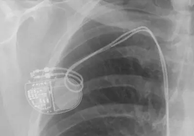 Radiograph from the case bank: Cardiac pacemaker