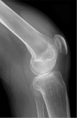 Radiograph from the case bank: Knee joint effusion
