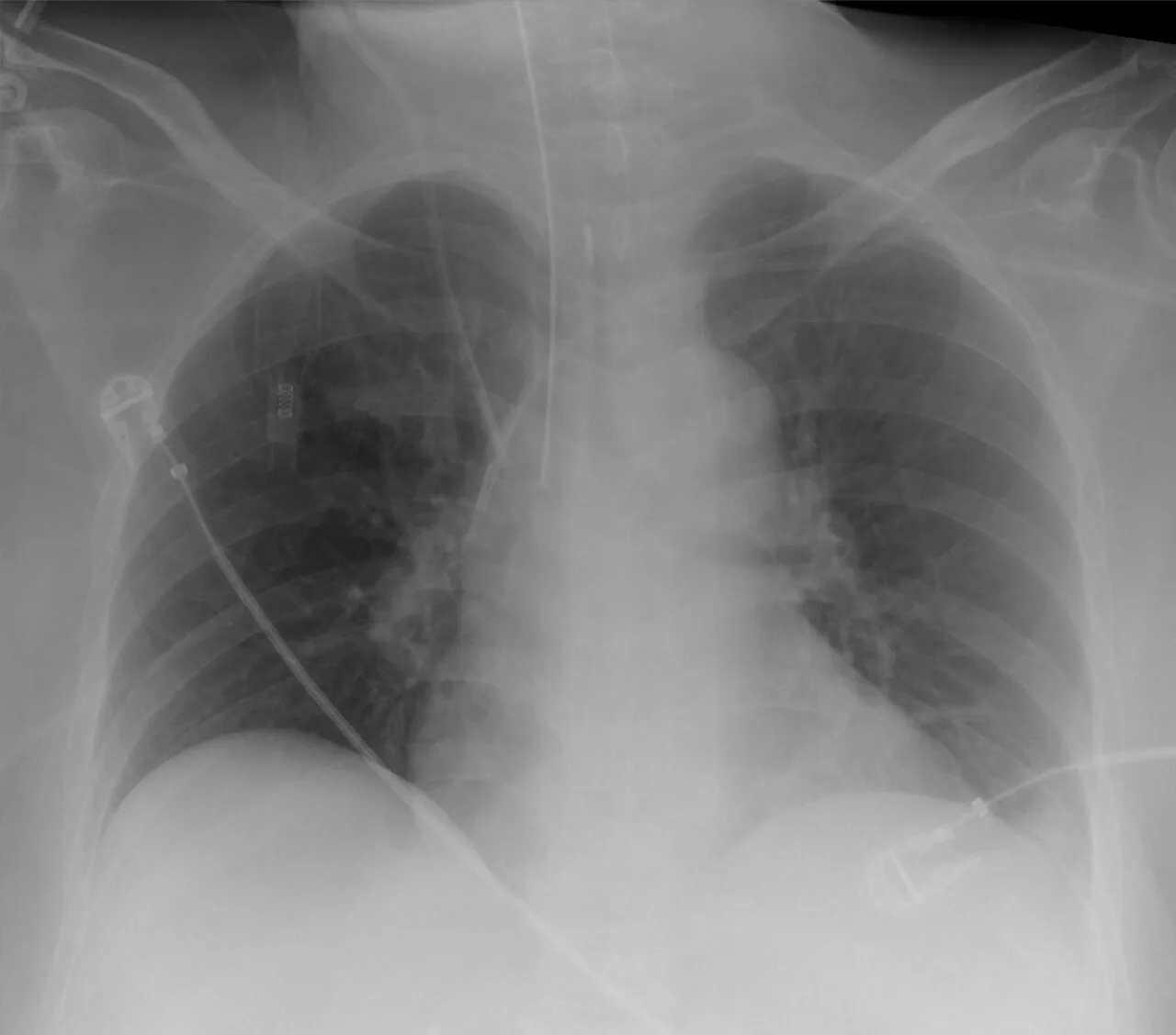 Lines & tubes radiograph for self-assessment