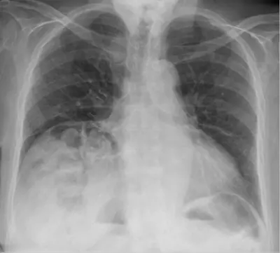 Radiograph from the case bank: Chilaiditi sign (colon interposed under the diaphragm)