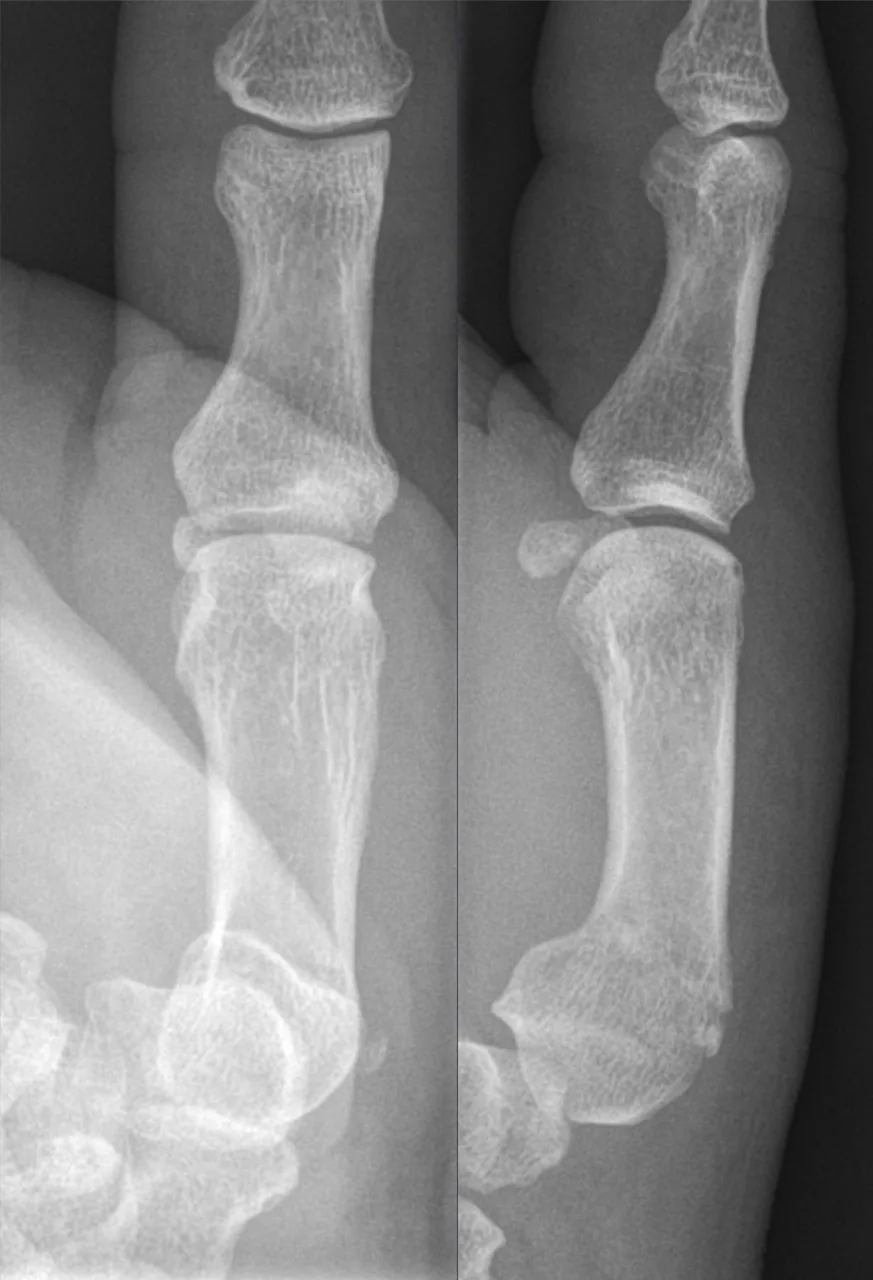 Upper limb radiograph for self-assessment