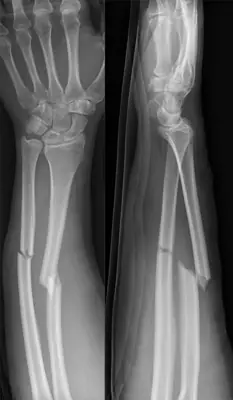 Radiograph from the case bank: Forearm shaft fracture (radius and ulna)