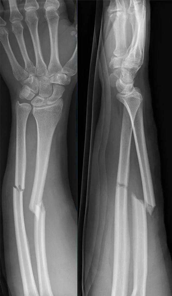 Upper limb radiograph for self-assessment