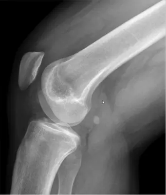 Radiograph from the case bank: Knee joint effusion