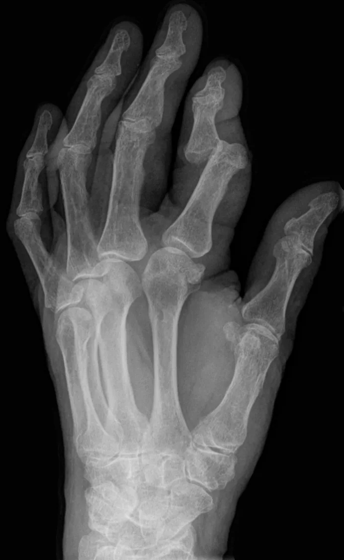 Upper limb radiograph for self-assessment
