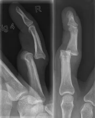 Radiograph from the case bank: Finger (interphalangeal) dislocation