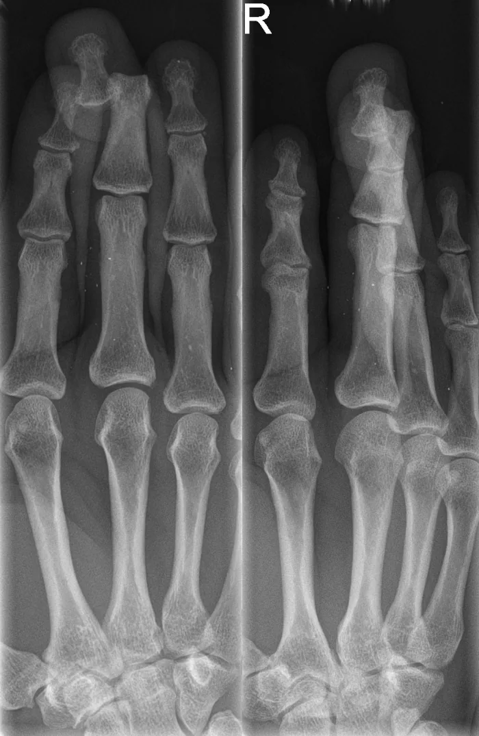 Upper limb radiograph for self-assessment
