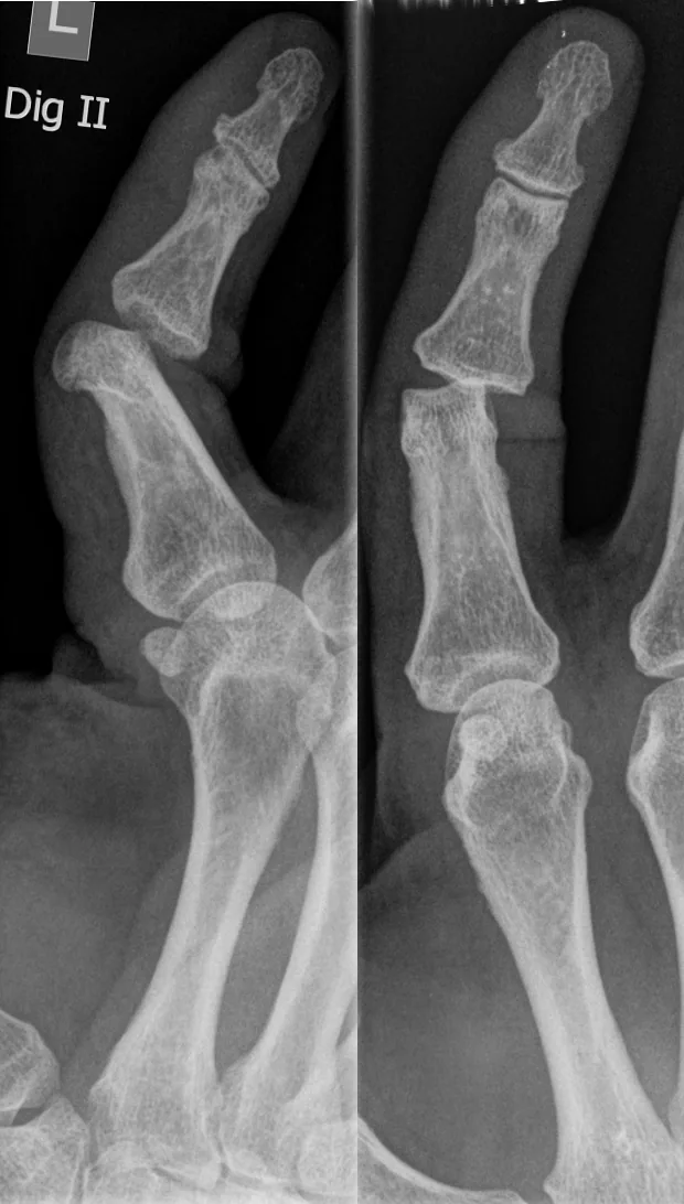 Upper limb radiograph for self-assessment
