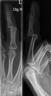Radiograph from the case bank: Finger (interphalangeal) dislocation