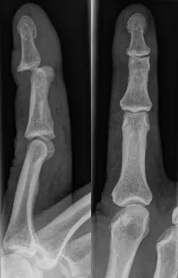 Radiograph from the case bank: Finger (interphalangeal) dislocation