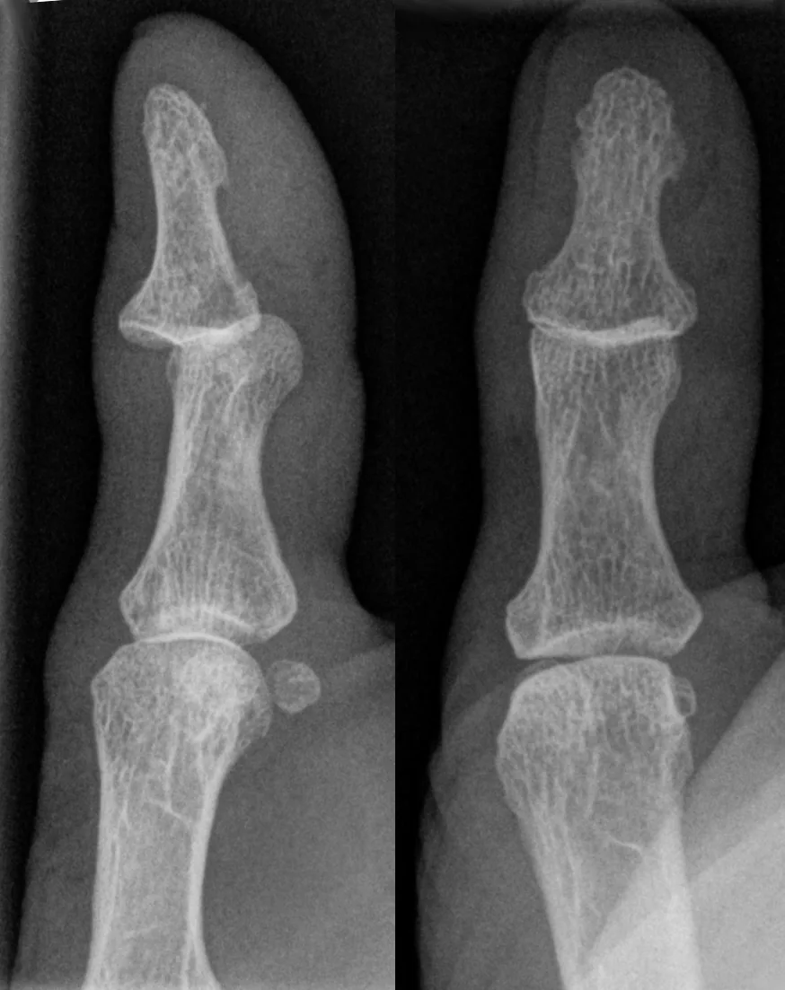 Upper limb radiograph for self-assessment