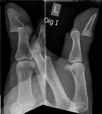 Radiograph from the case bank: Finger (interphalangeal) dislocation