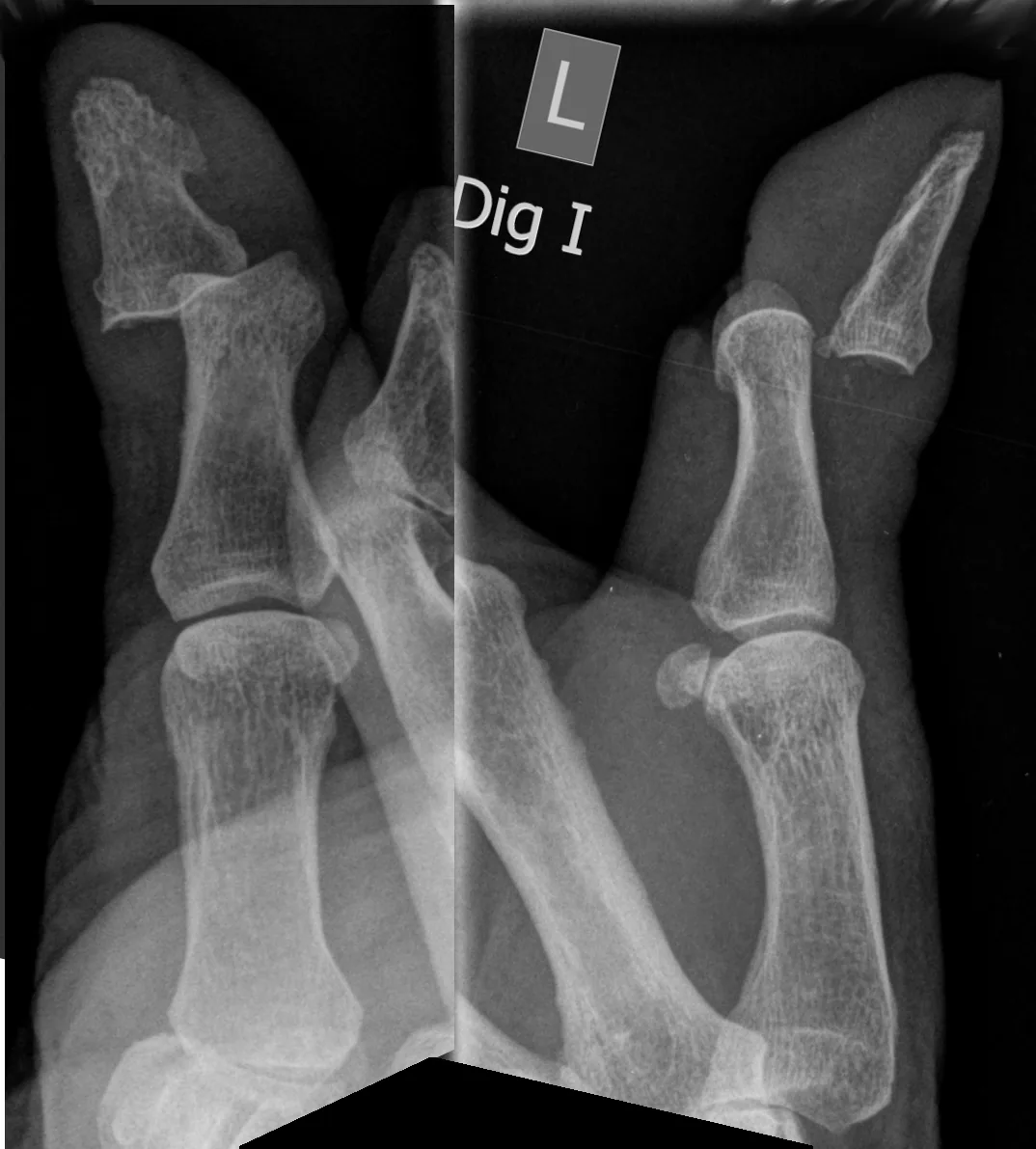 Upper limb radiograph for self-assessment