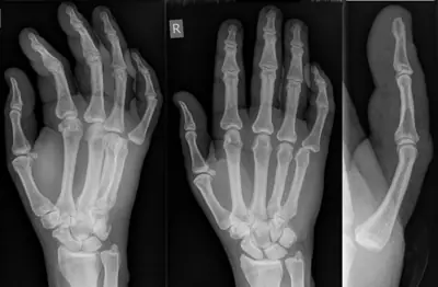 Radiograph from the case bank: Finger (interphalangeal) dislocation