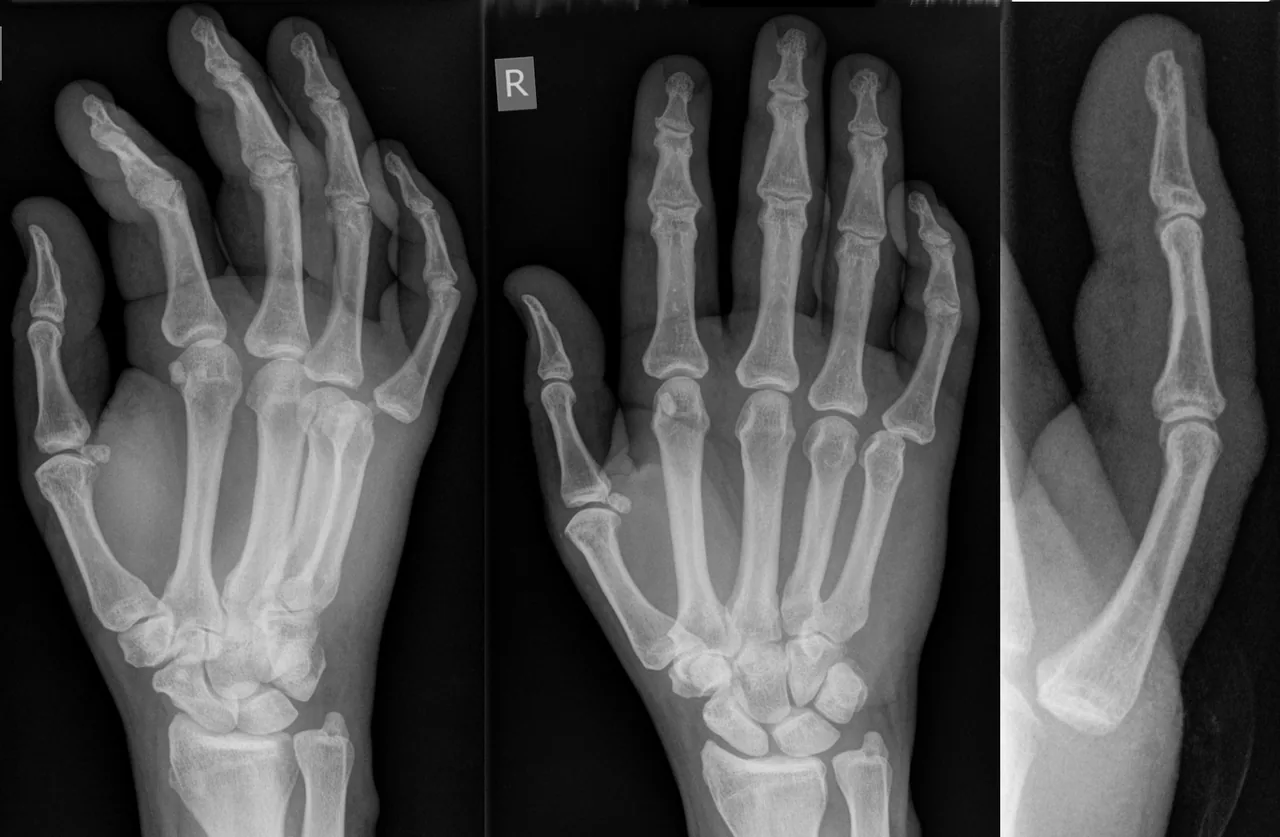 Upper limb radiograph for self-assessment