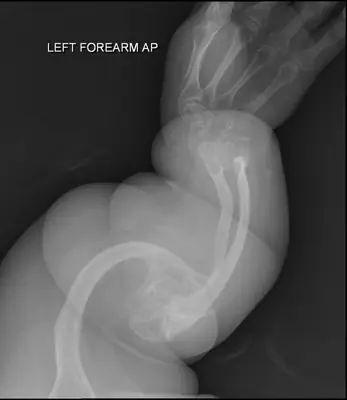 Radiograph from the case bank: Osteogenesis imperfecta