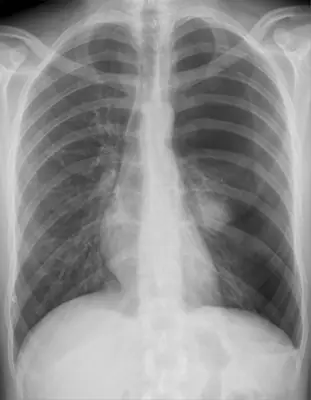Radiograph from the case bank: Pneumothorax