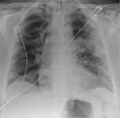 Radiograph from the case bank: COVID-19 pneumonia