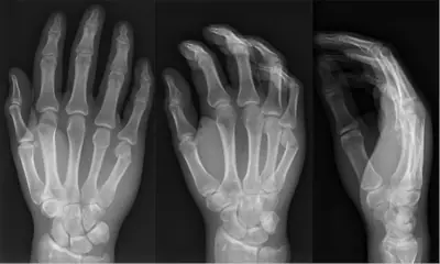 Radiograph from the case bank: Metacarpal fracture