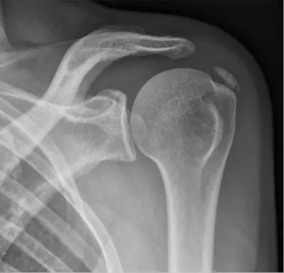 Radiograph from the case bank: Calcific tendinitis