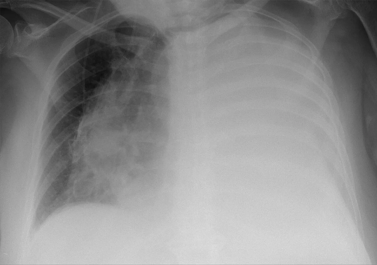 Chest radiograph for self-assessment
