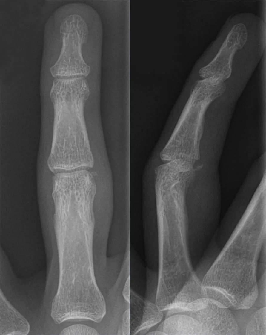 Upper limb radiograph for self-assessment