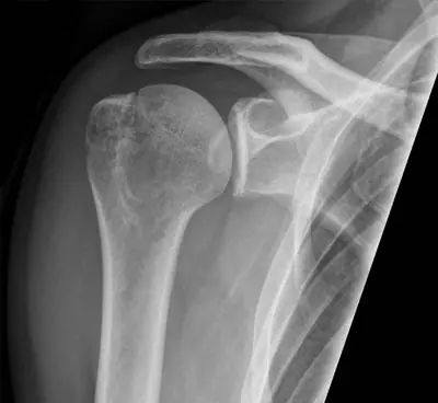 Radiograph from the case bank: Proximal humerus fracture
