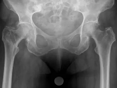 Radiograph from the case bank: Hip (proximal femoral) fracture